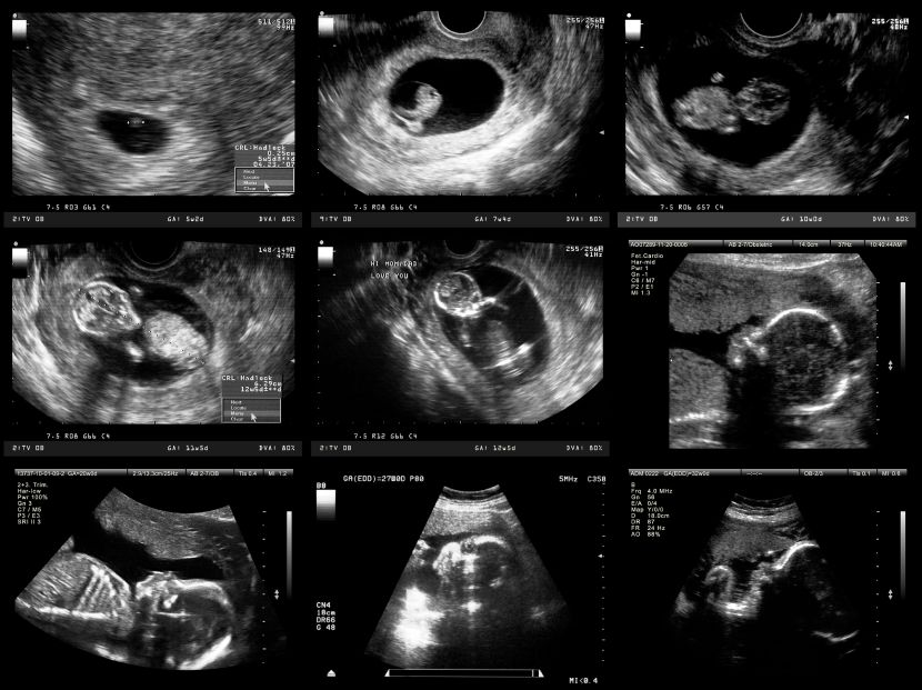 download detection of fetal abnormalities