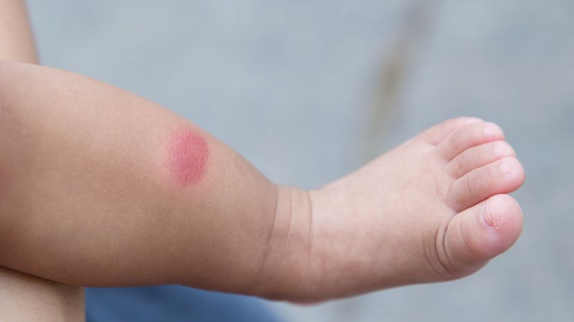15 Hausmittel gegen Mückenstiche: Das hilft wirklich!