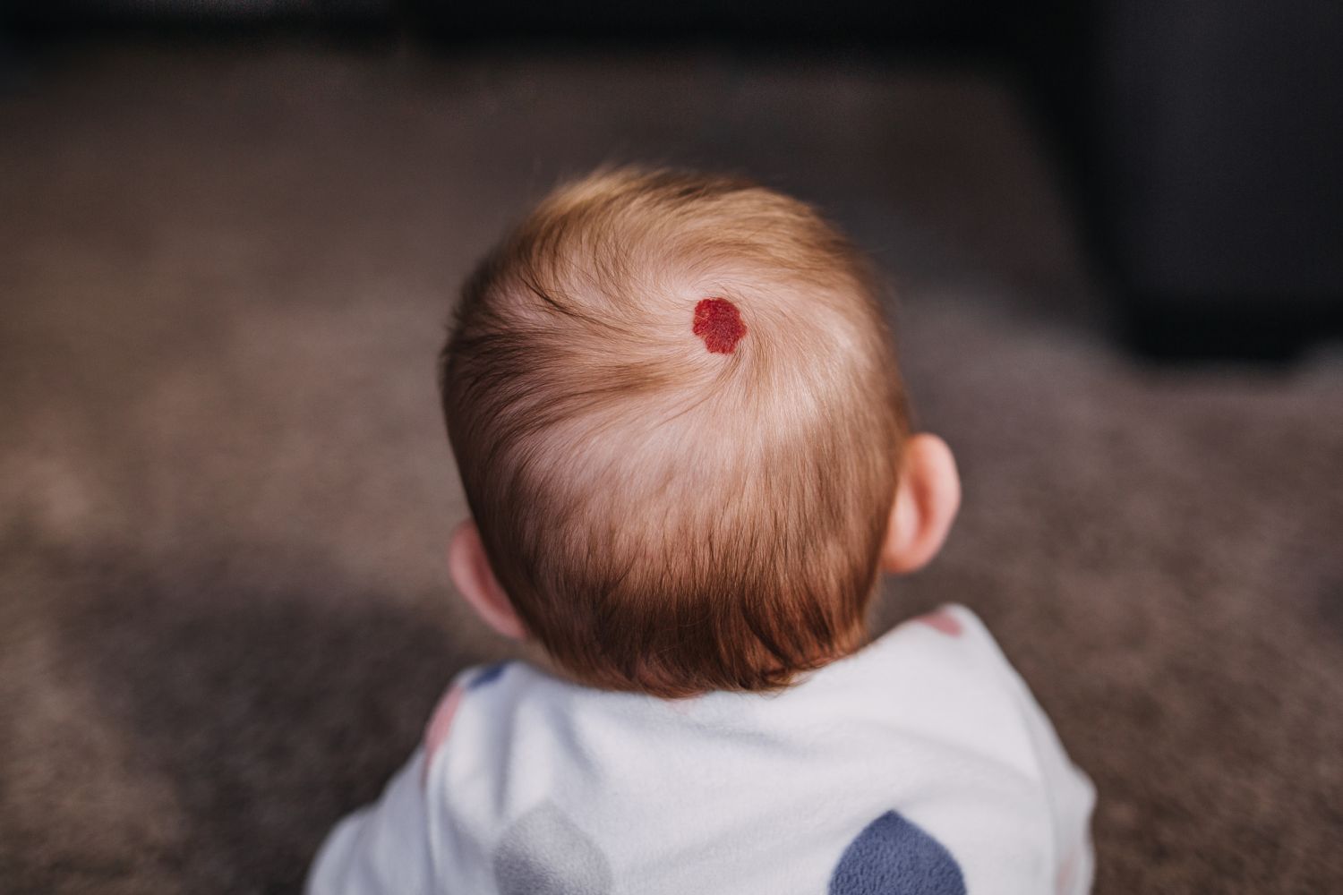 Красные затылки. Гемангиома на голове у ребенка. Родимое пятно на голове красное.