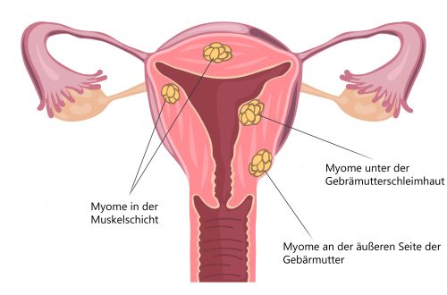 Knubbel am gebärmutterhals