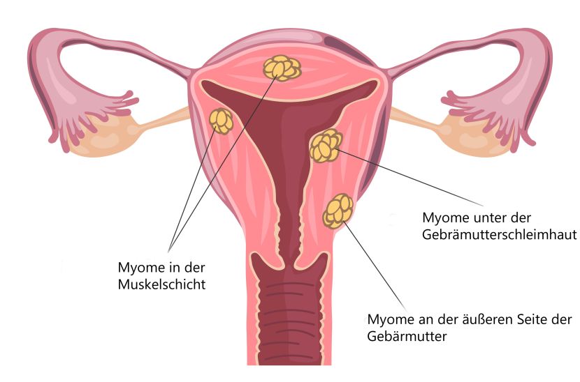 Myome Kinderwunsch Schwangerschaft Behandlung Risiken 9monate De