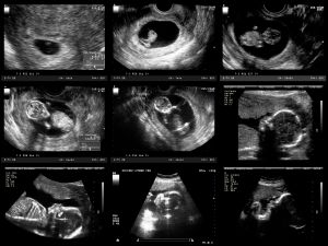 Junge ultraschall 12 ssw Ultraschall junge