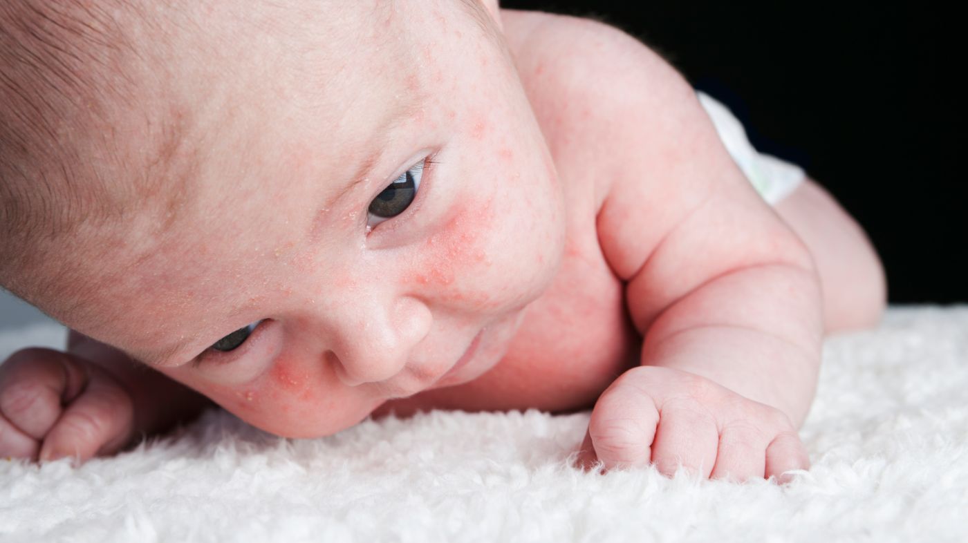 Hautprobleme Bei Babys Und Kindern 9monate De