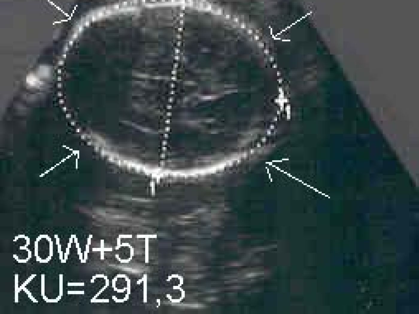 Tabelle schwangerschaft fod ku SSW Bauchumfang