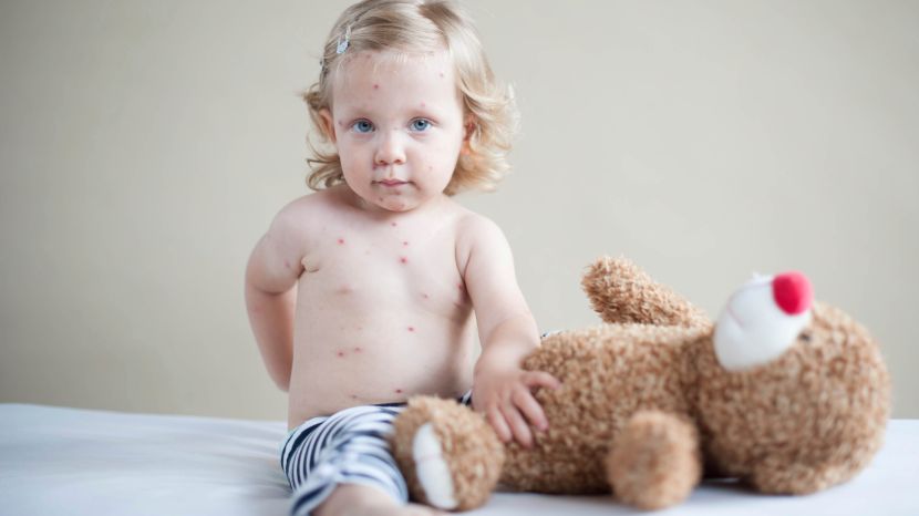 Masern: Babys sind besonders gefährdet