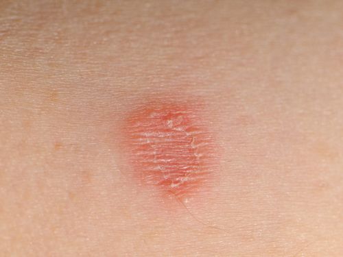 Tinea corporis: Pilzinfektion auf der Haut, übertragen durch Menschen und Tiere