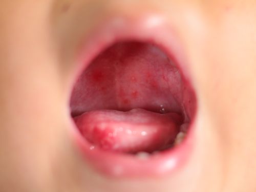 Bilder der Hand-Fuß-Mund-Krankheit: Ausschlag im Mund gehört zum klassischen Verlauf