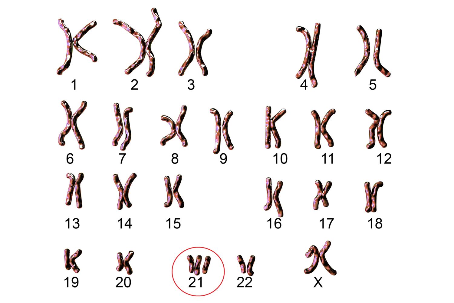 Down Syndrome Chromosome Map