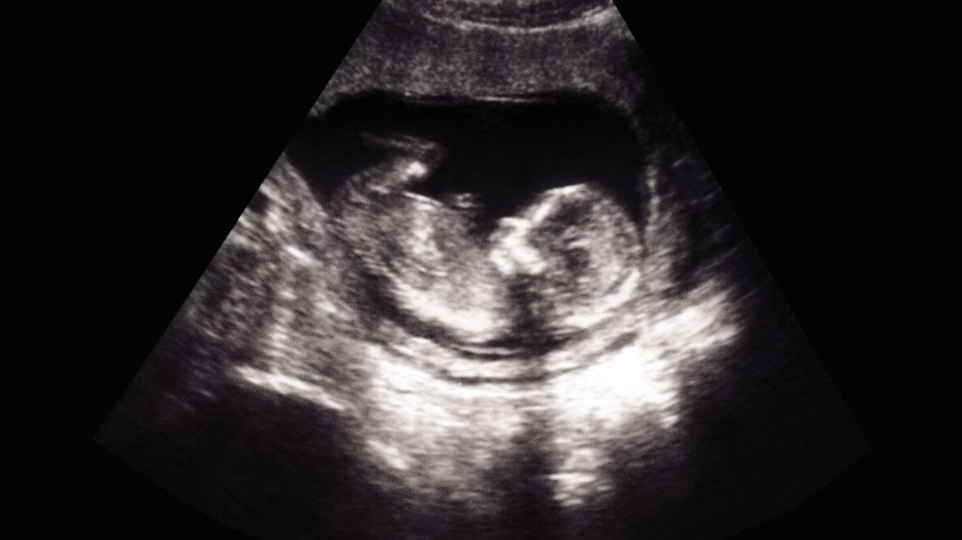 12 junge ultraschall ssw Ultraschall: Ab