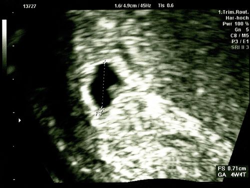 Ultraschallbild aus der 5. SSW